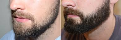 beard transplant